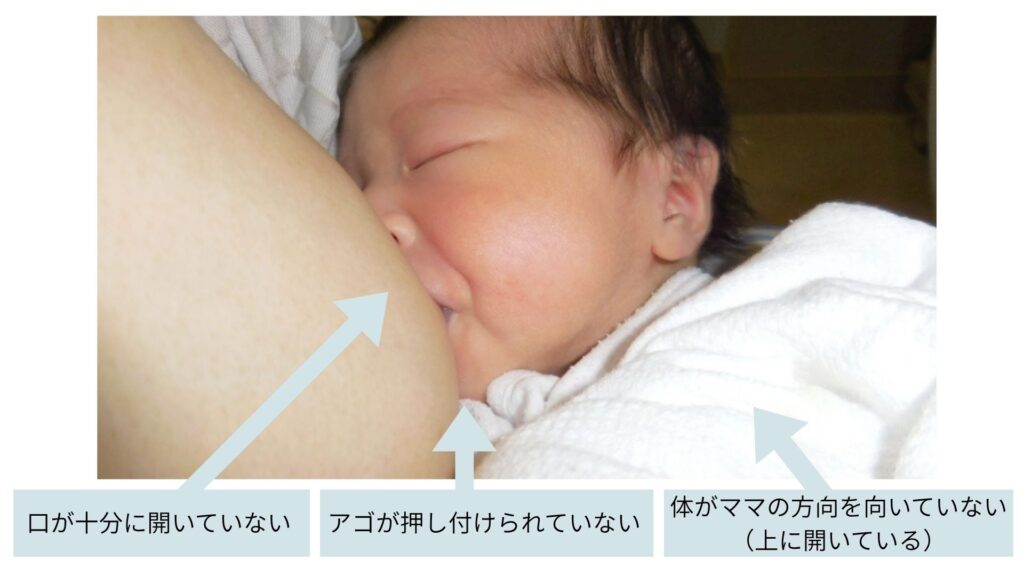 乳腺炎のセルフケア、自宅でできる対処法